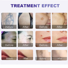 808 Diode Laser Hair Removal Device And Picosecond 2in1 Ice Titanium Laser Body Hair Removal Machine Tattoo Removal Machine
