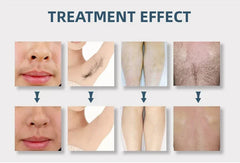Diode Laser and Picosecond Laser 2 in 1 808 Diode Laser Hair Removal Tattoo Removal Machine with 4 Wavelength 755 808 940 1064nm